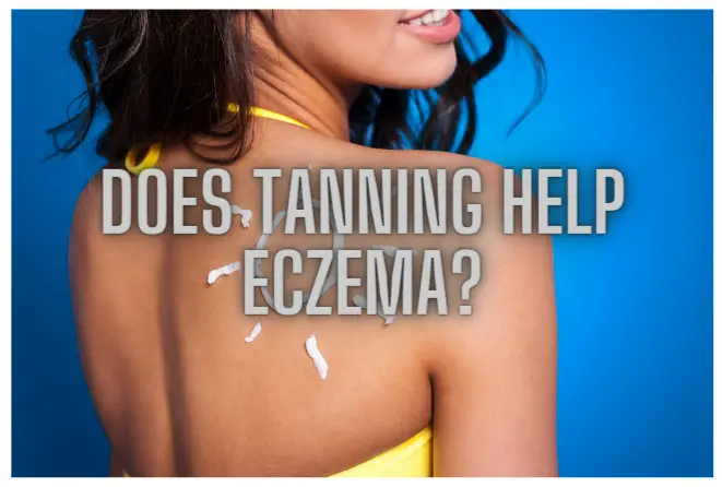 does-tanning-help-eczema-eczemafeed